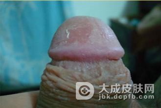 你对淋病的有这样的错误认识吗
