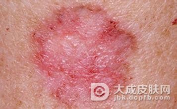 红斑狼疮忌一下三种食物