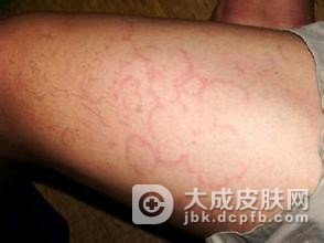 红斑狼疮的预防护理应该怎么样做
