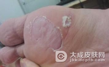 脚气平日应注意哪些呢