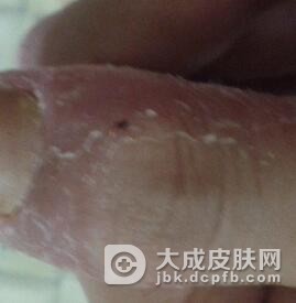 导致手癣因素有哪些