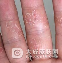 手癣会发生传染吗