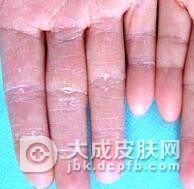 手癣有哪些治疗方法