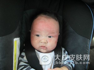 湿疹的主要症状