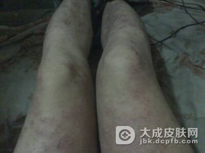 日常生活中婴儿湿疹的防治要点有哪些