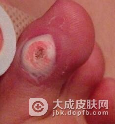 脚底鸡眼怎样预防