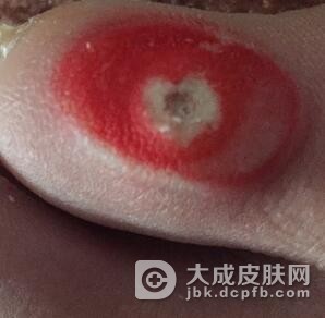鸡眼的病理