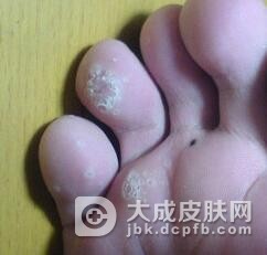 鸡眼的危害主要是什么