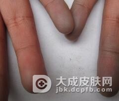 皮肌炎患者有哪些症状