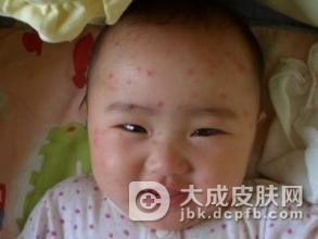 患上水痘用什么药好