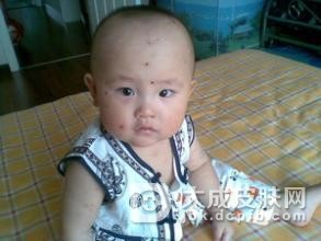 水痘的传播途径一般都有哪些