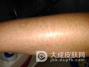 回旋形线状鱼鳞病的保健方法
