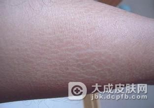 回旋形线状鱼鳞病吃水果有何禁忌