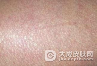 回旋形线状鱼鳞病有哪些特征