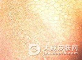 不及时治疗回旋形线状鱼鳞病的危害
