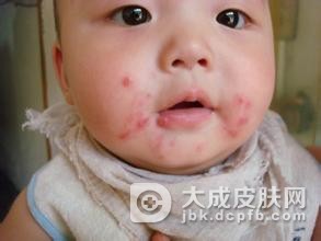 新生儿脓疱疮该怎样护理