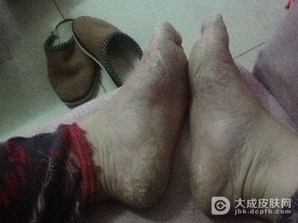 水疱型脚气有哪些症状
