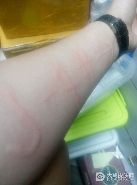 色素性荨麻疹的简单介绍