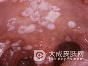 口腔念珠菌病的预防措施有哪些