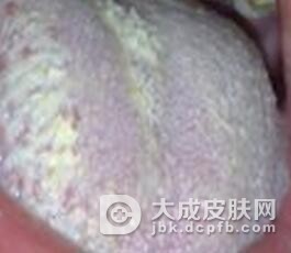 念珠菌病的诱发因素是什么