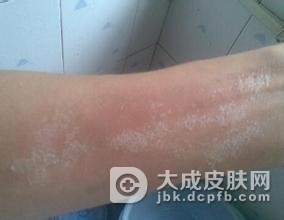 冬季怎么减轻瘙痒症状