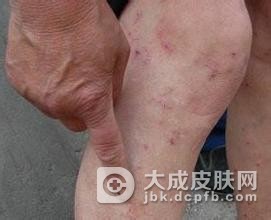 怎样预防冬季皮肤瘙痒呢
