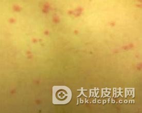 药物使用不当也会导致皮肤过敏