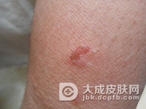 出现皮肤过敏切勿乱用抗过敏药物