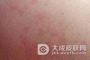 药物过敏后有什么症状
