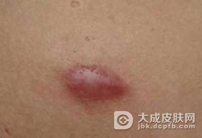 脂肪瘤的临床检查方法