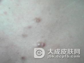 背部长毛囊炎是什么原因导致的