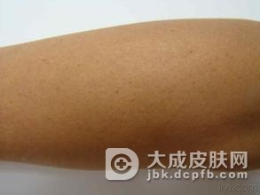 遗传性对称性色素异常症是由什么原因引起的