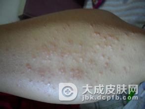 扁平疣患者如何保护皮肤