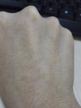 扁平疣患者发病的原因是什么
