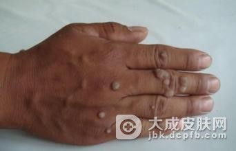 扁平疣发病的原因主要是什么