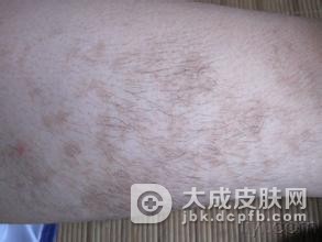 体癣是由什么原因引起的