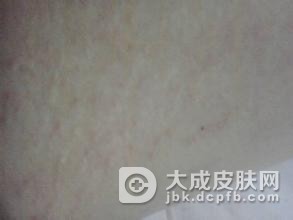 体癣治的好吗用什么药有效