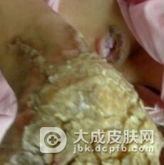 药物性皮炎要怎么预防