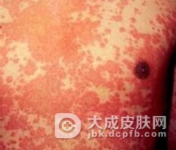 药物性皮炎的特殊类型有什么