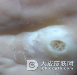 鸡眼是什么原因导致的