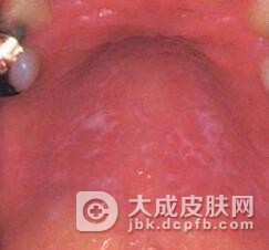 舌扁平苔藓是怎么引起的