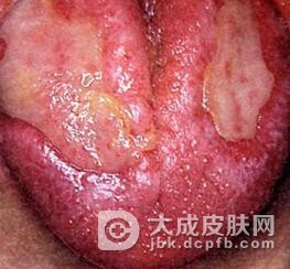 舌扁平苔藓的症状