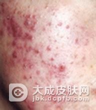 日常生活中预防青春痘的方法