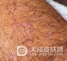 疱疹样皮炎严重吗