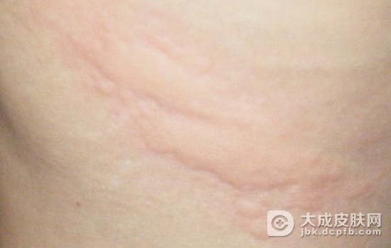 麻疹的治疗及其注意事项