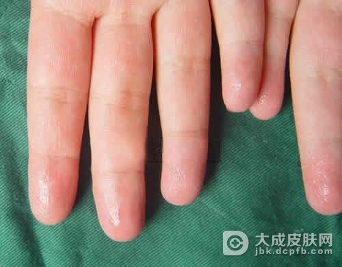 多汗症危害主要是哪些