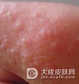 汗疱疹是什么症状