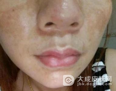 失眠也会导致黄褐斑的形成吗