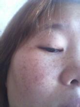 引起黄褐斑疾病的病因有哪些
