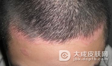 儿童头癣的护理重点是什么呢